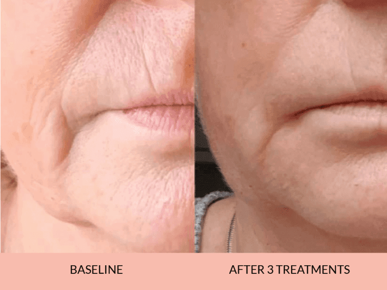 Dermal Filler Results