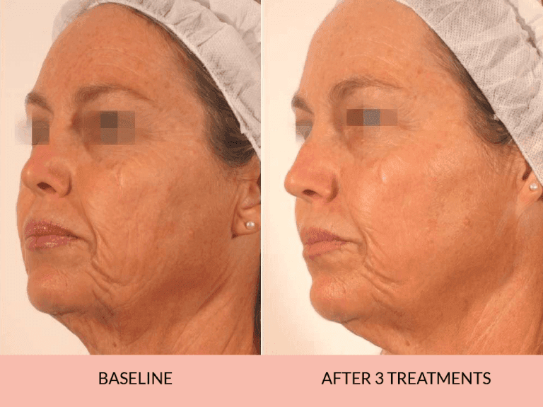 Jawline Contouring Results