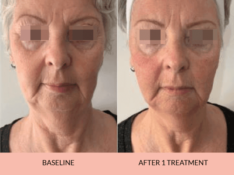 Skin Rejuvenation Results
