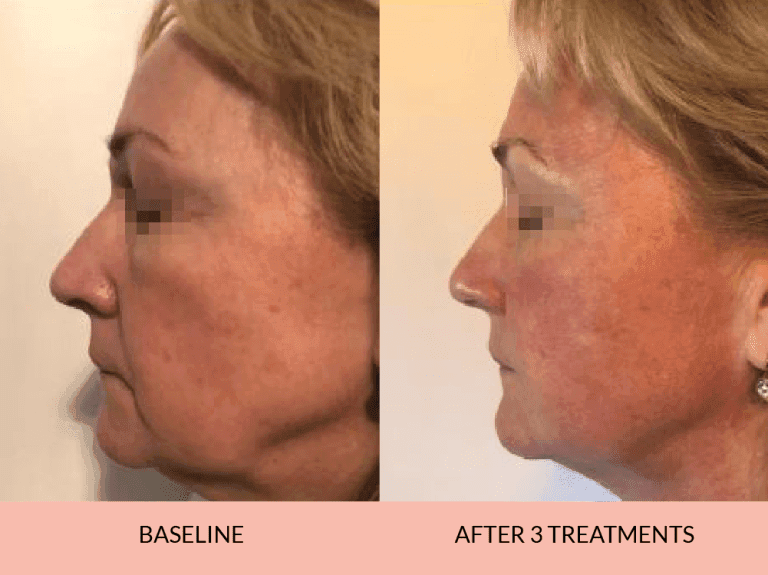 triLift Facelift Results
