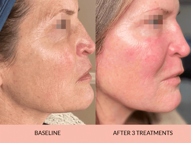 Skin Tightening Results