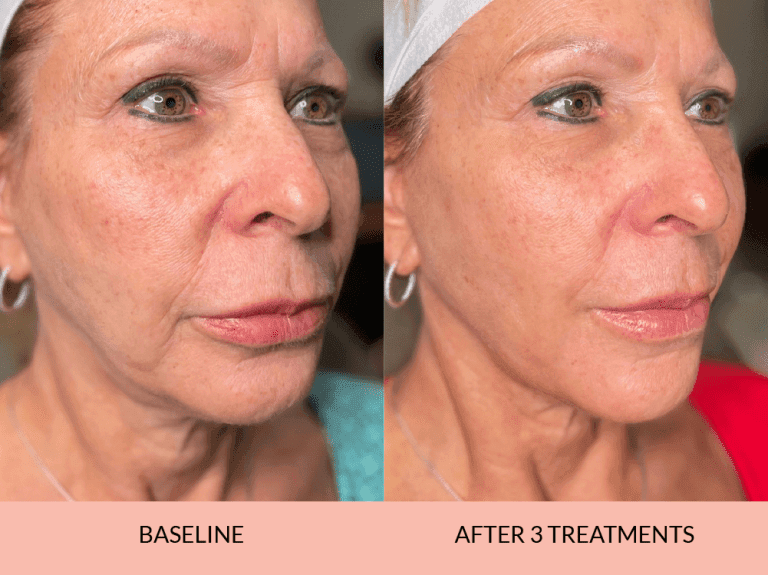 Facial Balancing Results