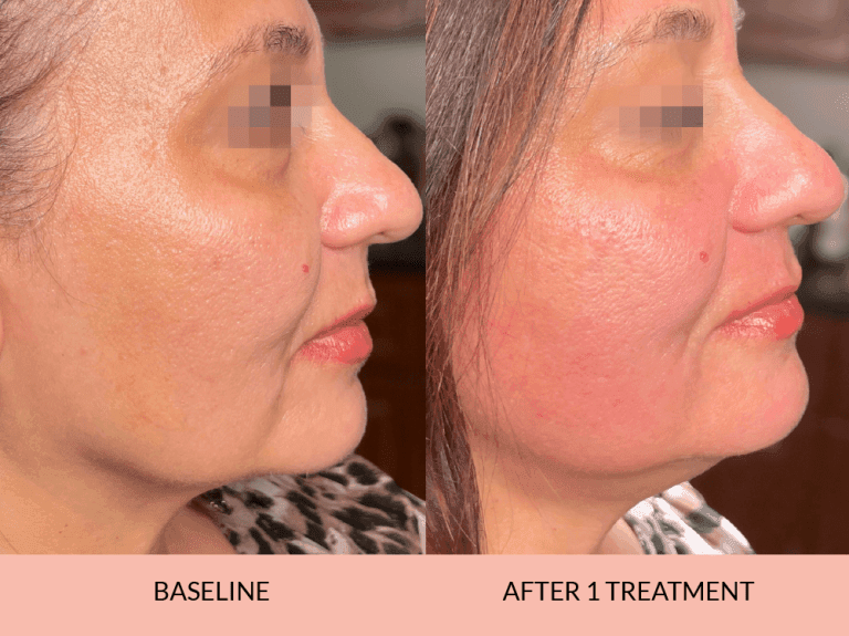 Full Face Rejuvenation