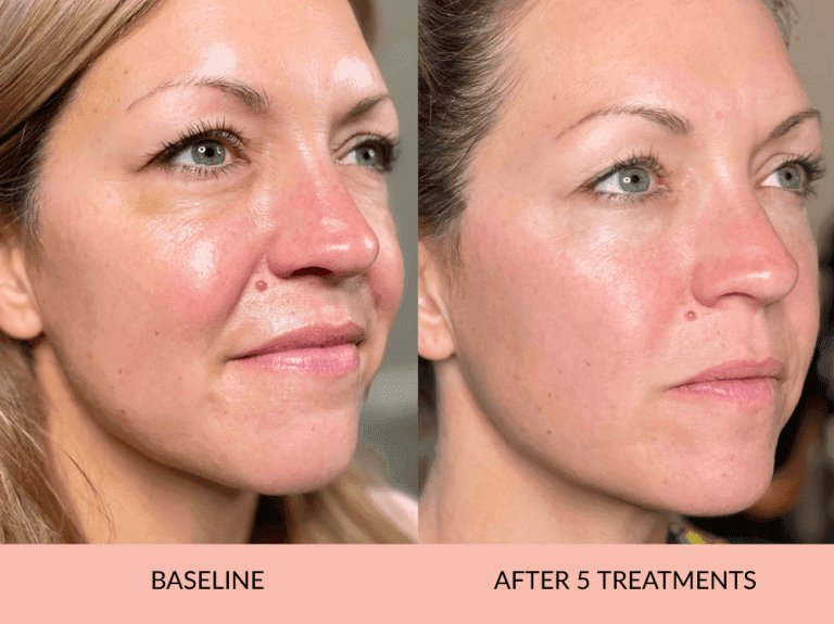 Nonsurgical Facelift Results