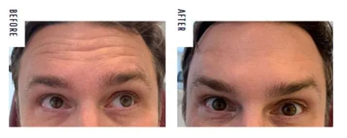 Botox before and after forehead smoothing at Grey Aesthetics Newport Beach