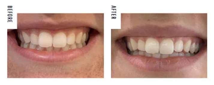 Botox before and after frown lines treatment at Grey Aesthetics Newport Beach