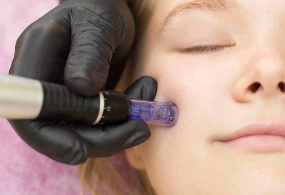 RF Microneedling