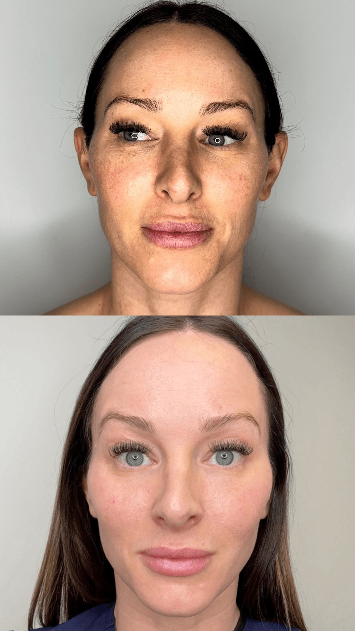 AgeJET before and after full face rejuvenation — pigmentation and skin tone