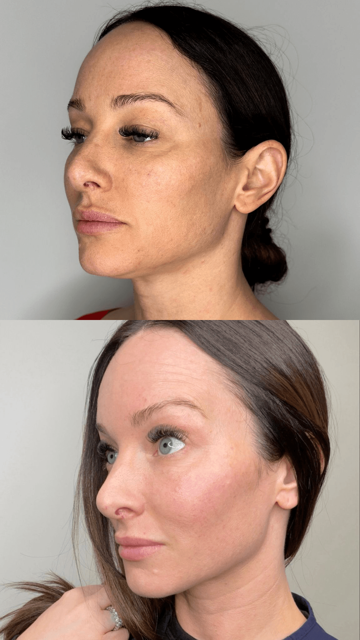 AgeJET before and after profile — skin firming and clarity