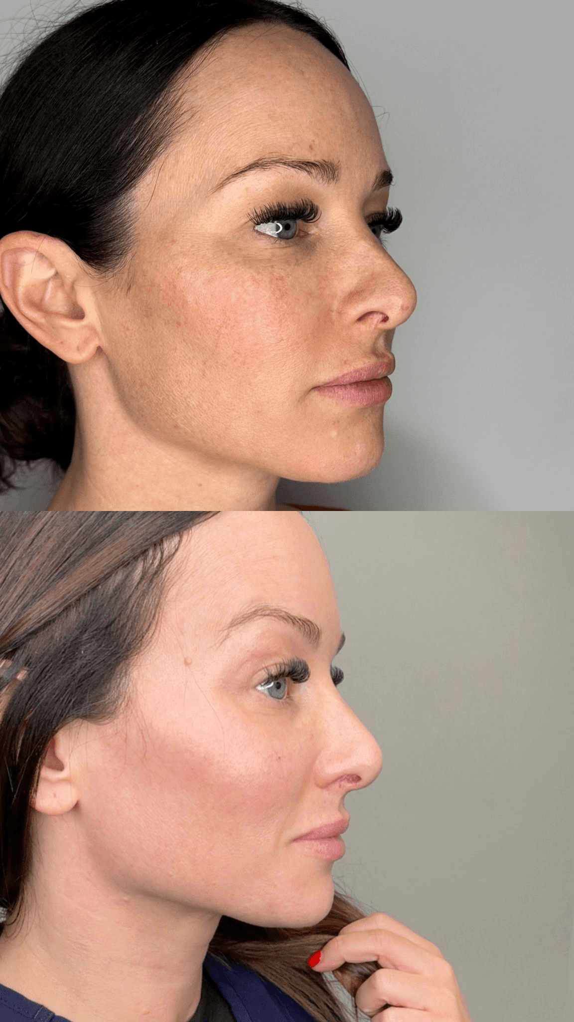 AgeJET before and after profile view — skin quality improvement