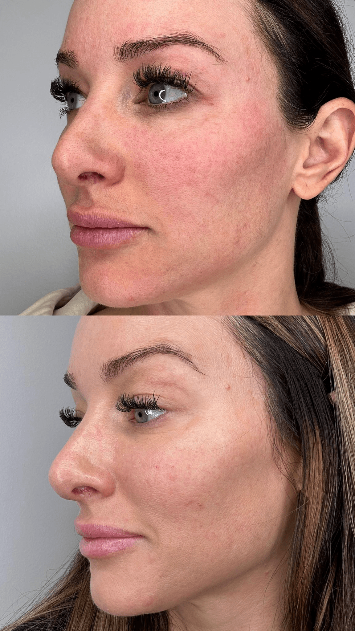 AgeJET before and after redness and pigmentation reduction