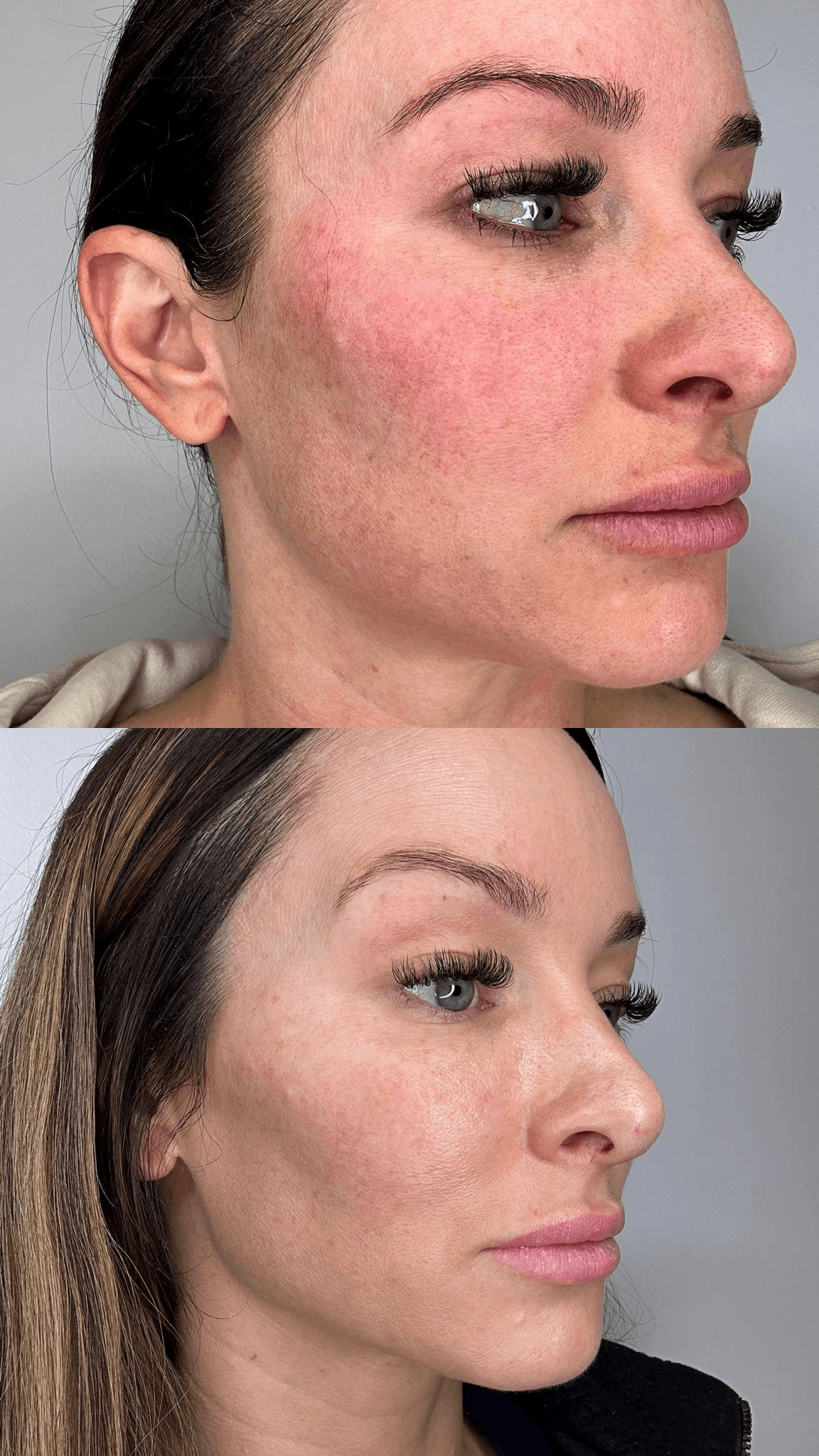 AgeJET before and after redness treatment — 3/4 view