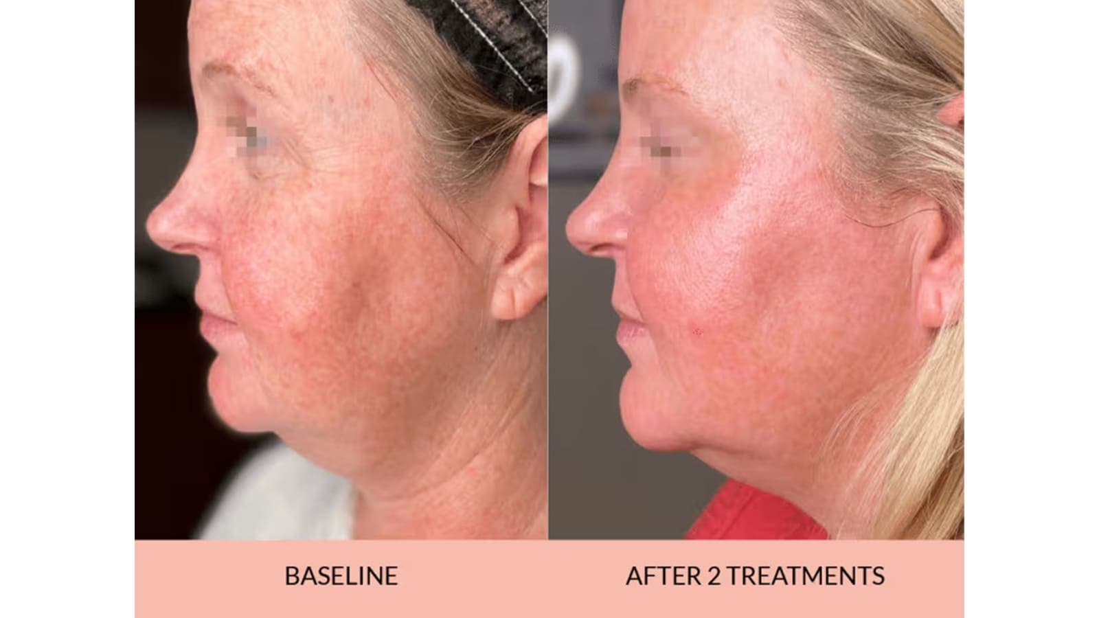 Botox before and after results at Grey Aesthetics Newport Beach