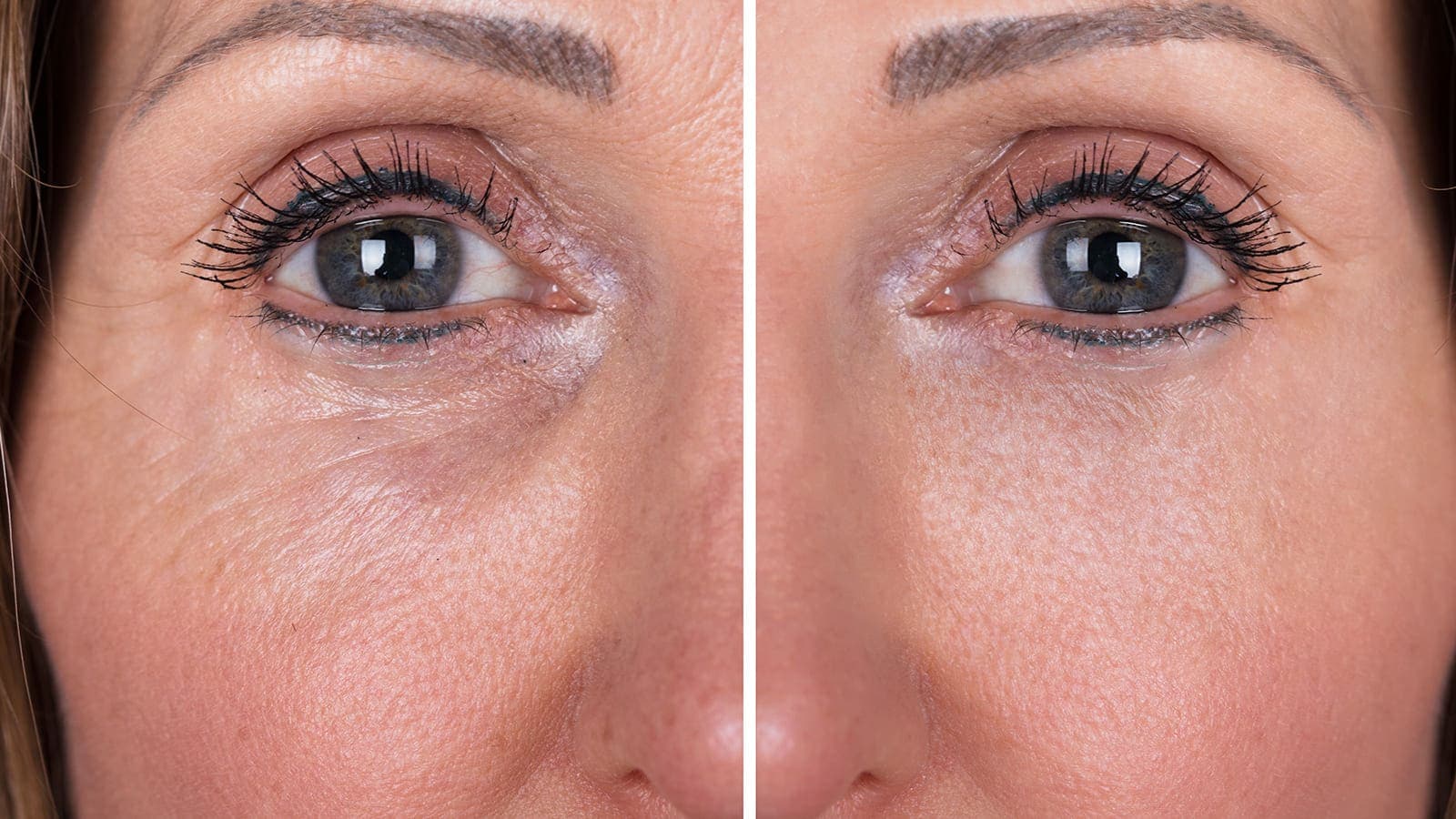 Benefits of Botox treatment at Grey Aesthetics Newport Beach