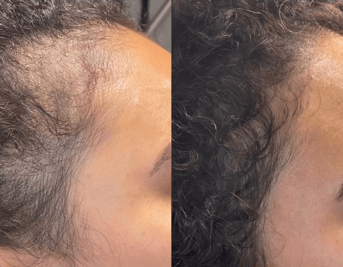 Keravive Scalp Treatment in Newport Beach: Benefits, Cost And Before After Results