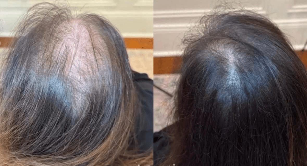 Hair restoration before and after results showing scalp improvement after Keravive treatment