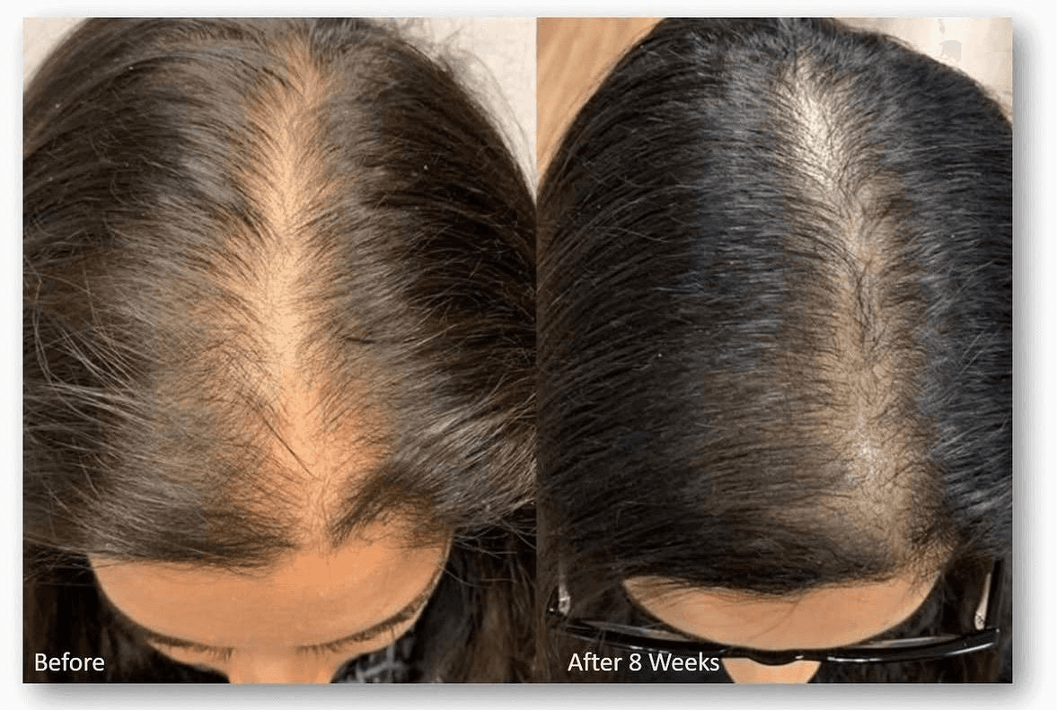Hair restoration before and after result — patient 3