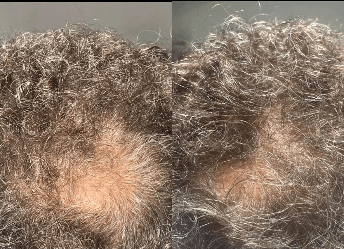 Hair restoration before and after result — patient 4