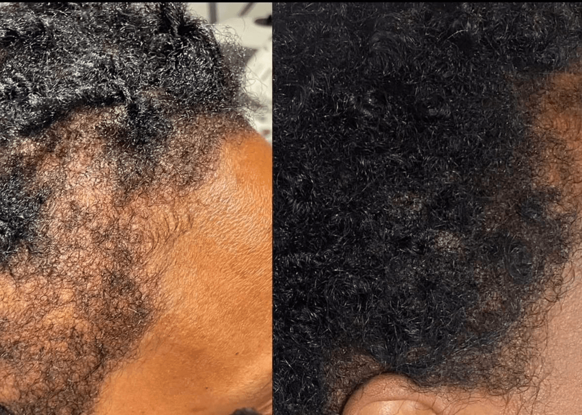 Hair restoration before and after result — patient 5