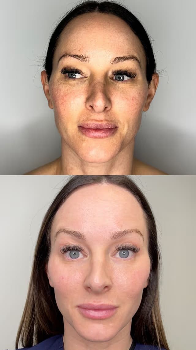 Skin tone and pigmentation result, Grey Aesthetics Newport Beach