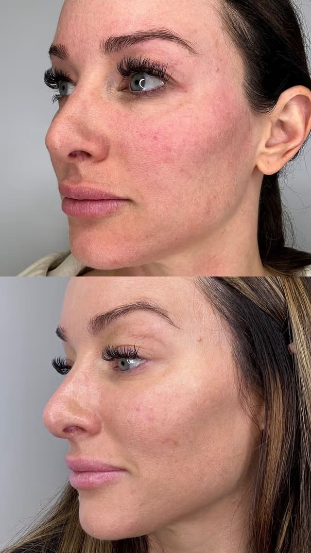 Skin tone and pigmentation result, profile, Grey Aesthetics Newport Beach