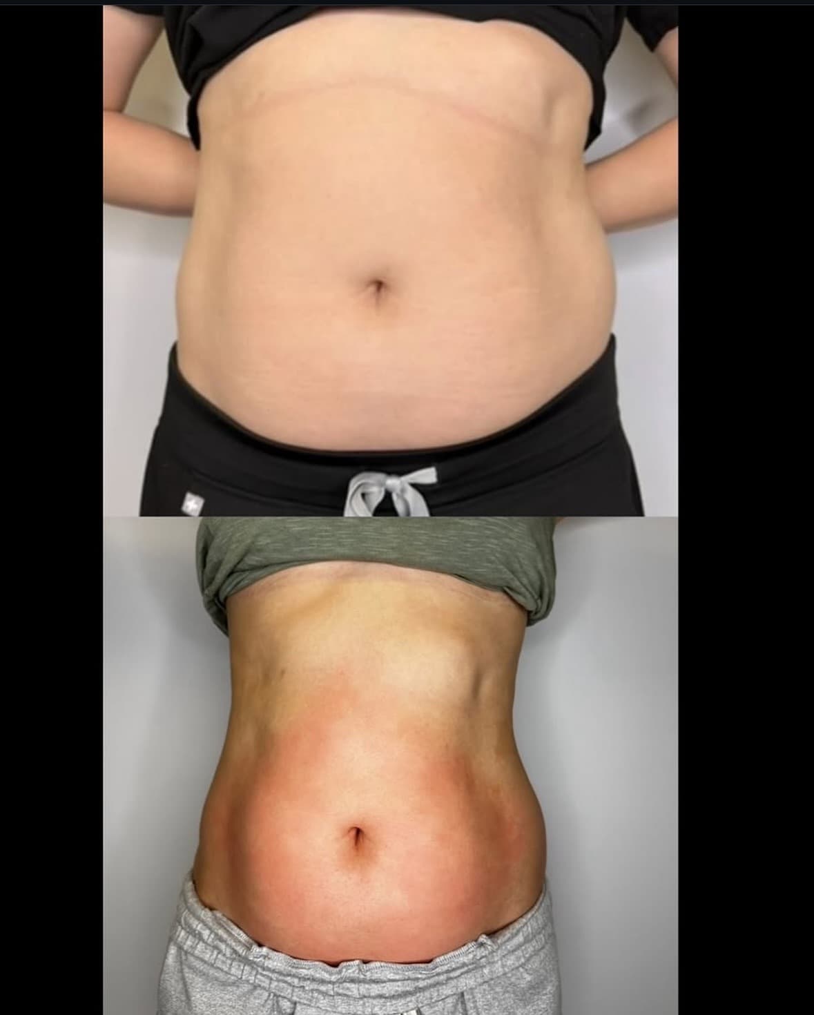 Abdomen sculpting result, Grey Aesthetics Newport Beach