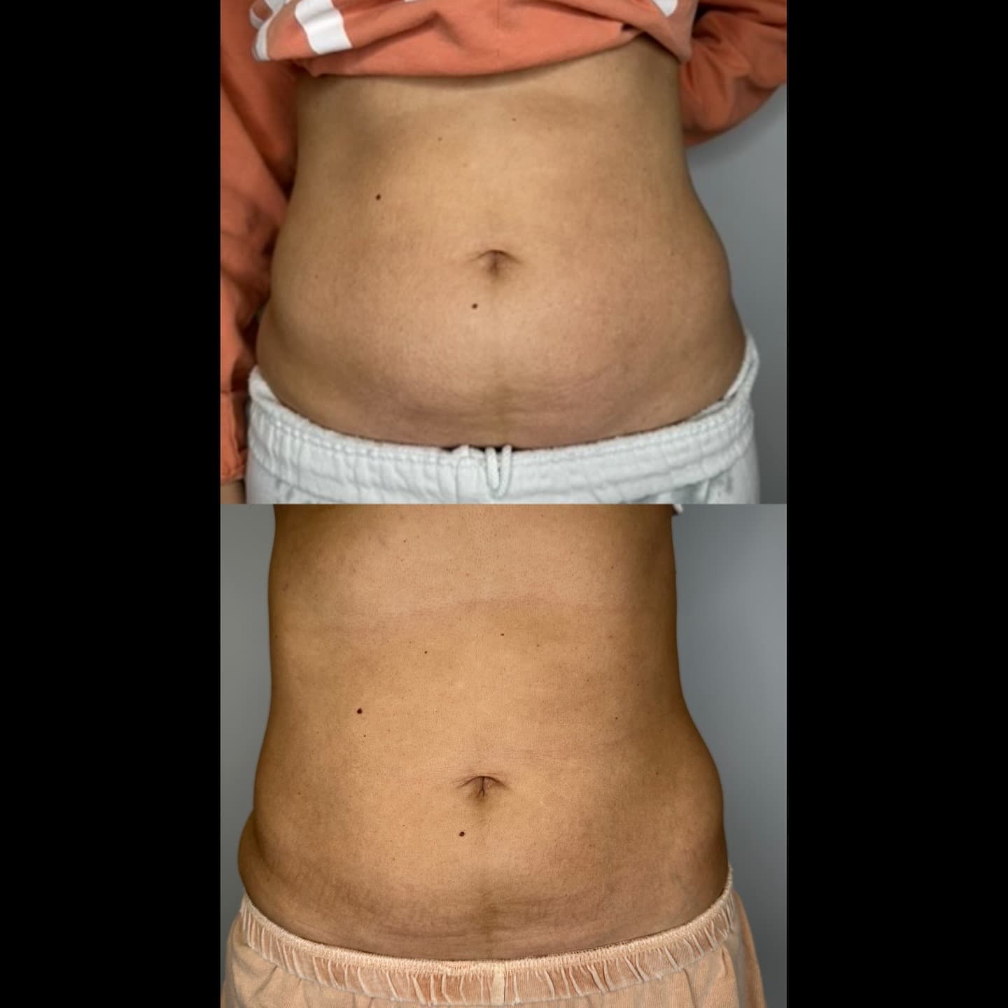 Abdomen contouring result, Grey Aesthetics Newport Beach