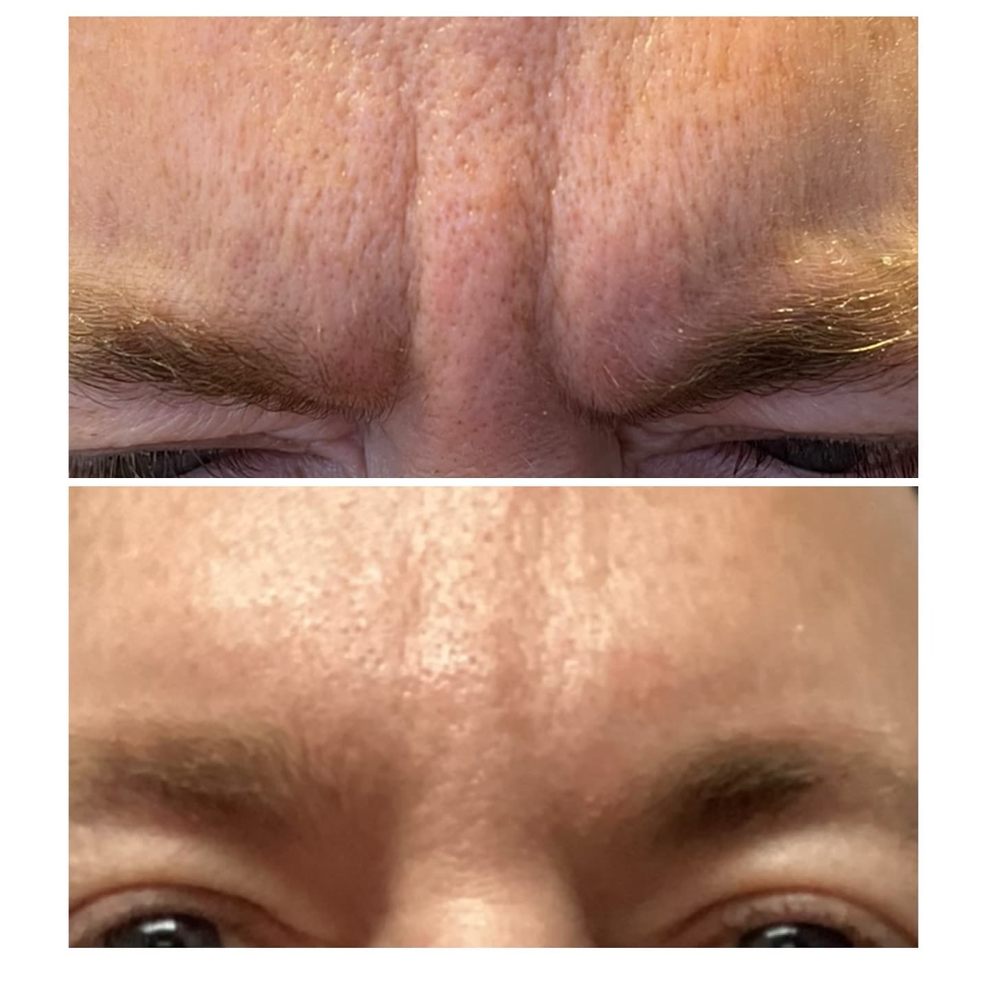 Forehead line result, Grey Aesthetics Newport Beach