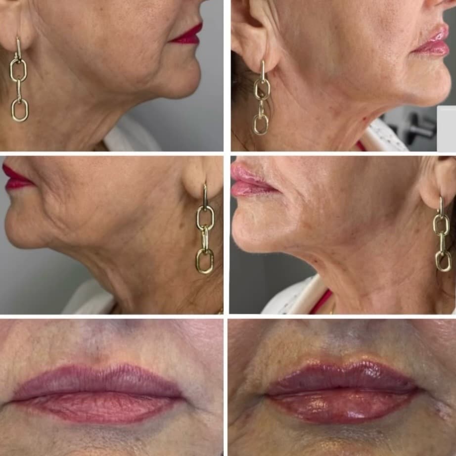 Chin, jawline, and lip filler result, Grey Aesthetics Newport Beach