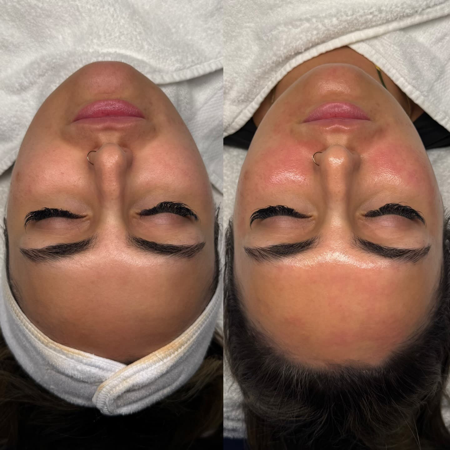 Forehead texture result, Grey Aesthetics Newport Beach