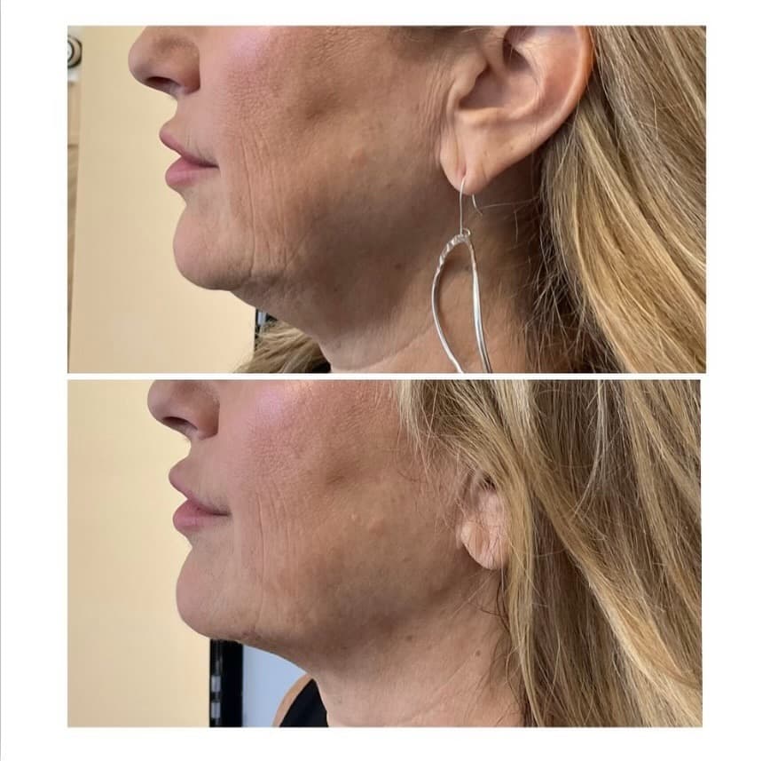 Jawline profile result, Grey Aesthetics Newport Beach