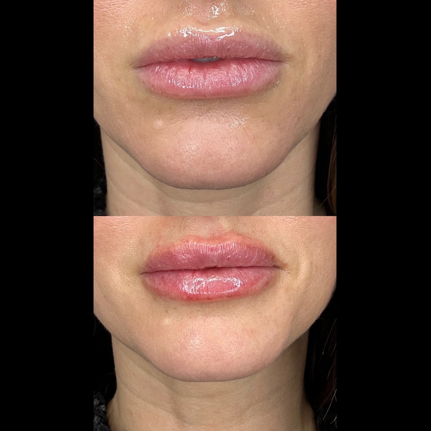 Lip volume result, Grey Aesthetics Newport Beach