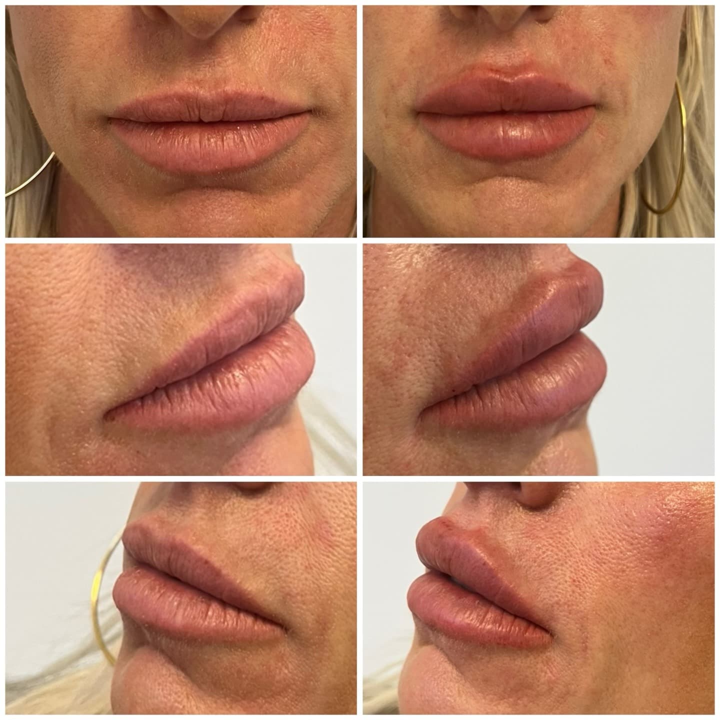 Lip shape result, two angles, Grey Aesthetics Newport Beach