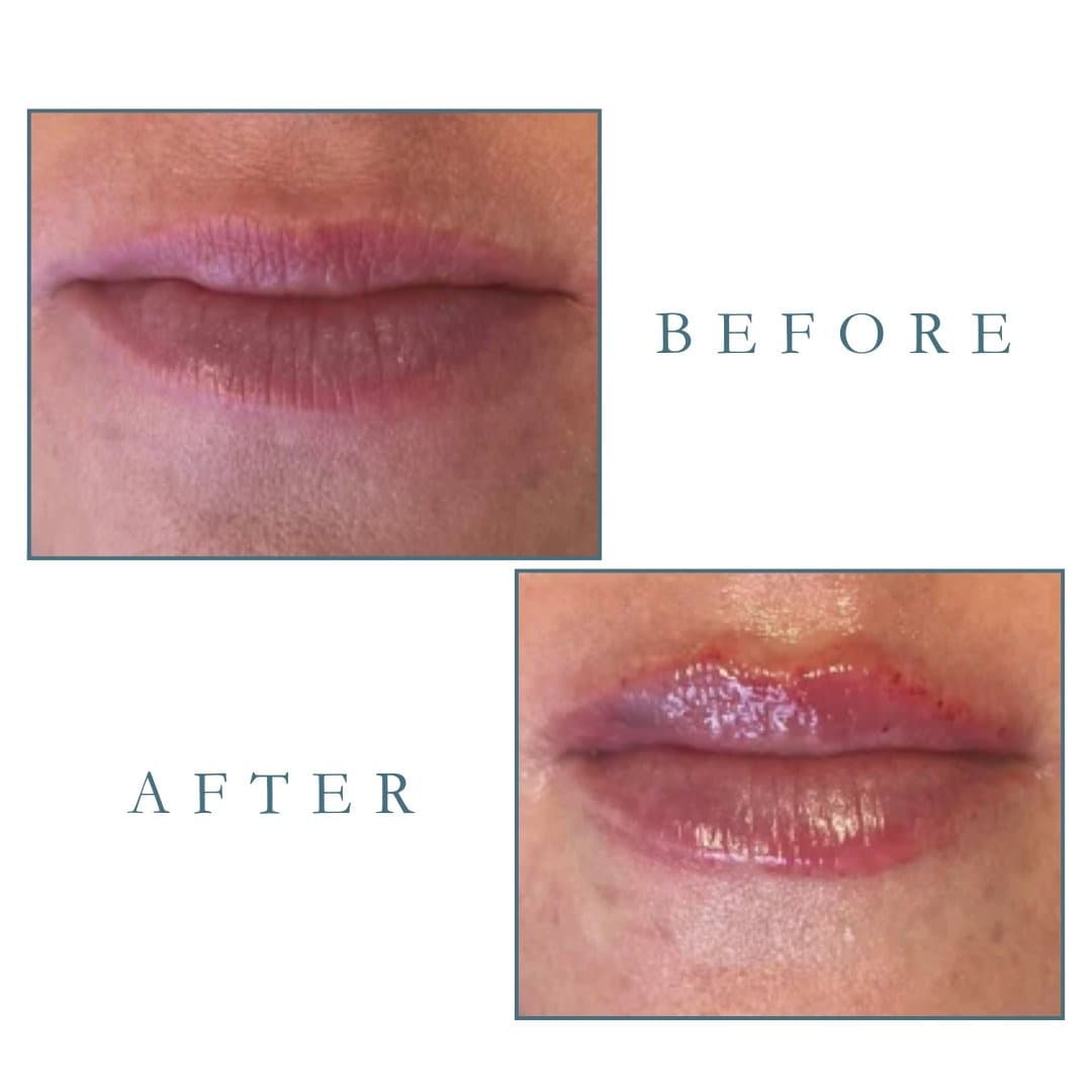 Lip contour result, Grey Aesthetics Newport Beach
