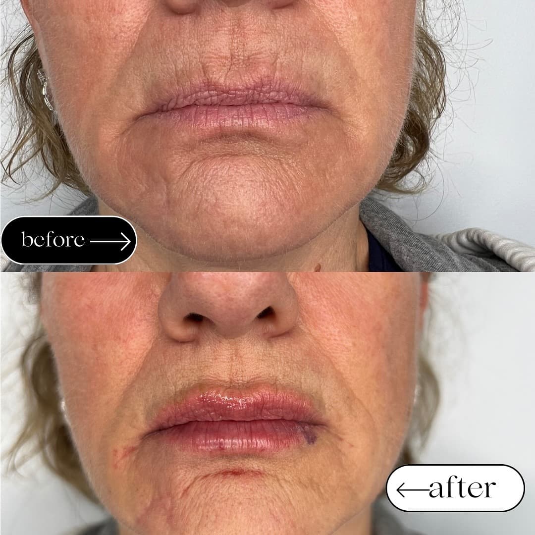 Full face lip filler result, Grey Aesthetics Newport Beach