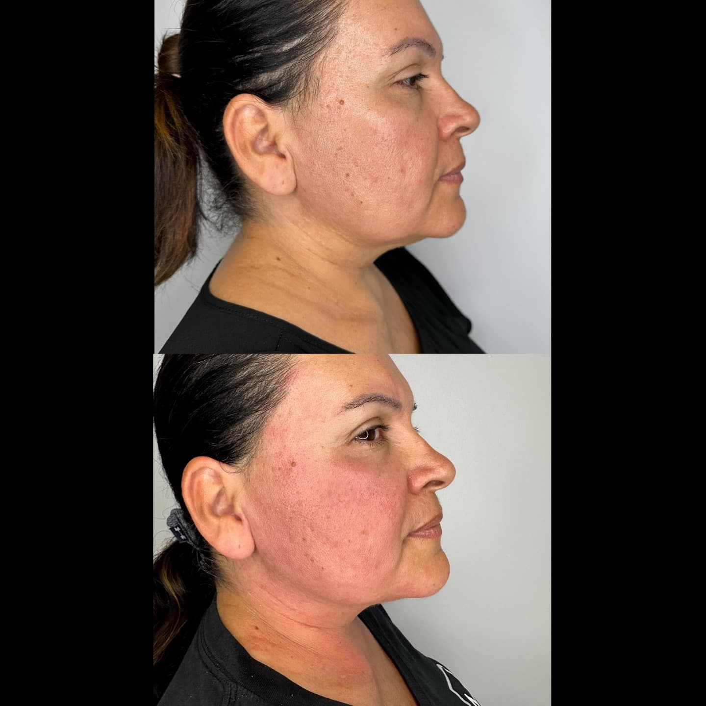 Side profile improvement, Grey Aesthetics Newport Beach