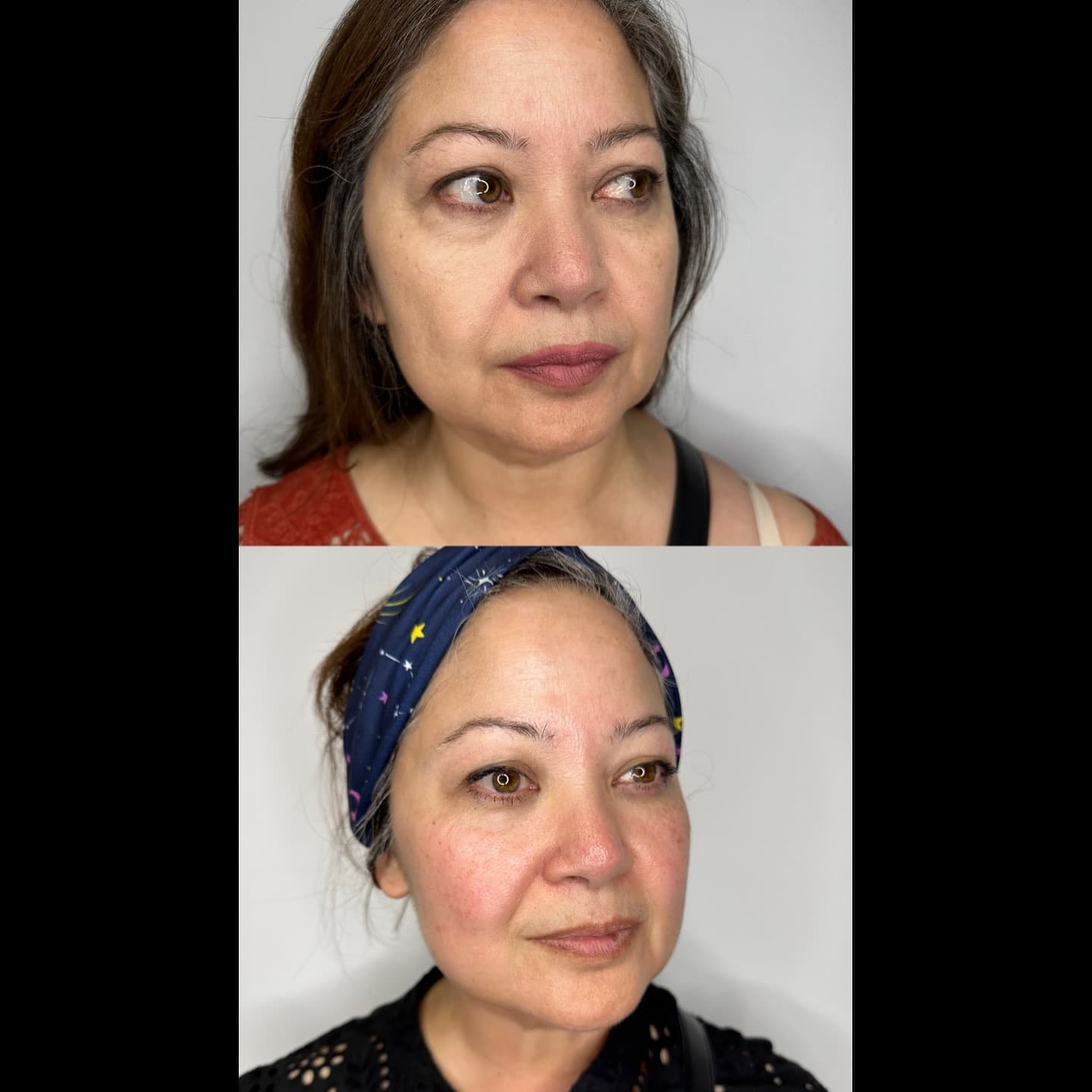 Full face improvement, Grey Aesthetics Newport Beach