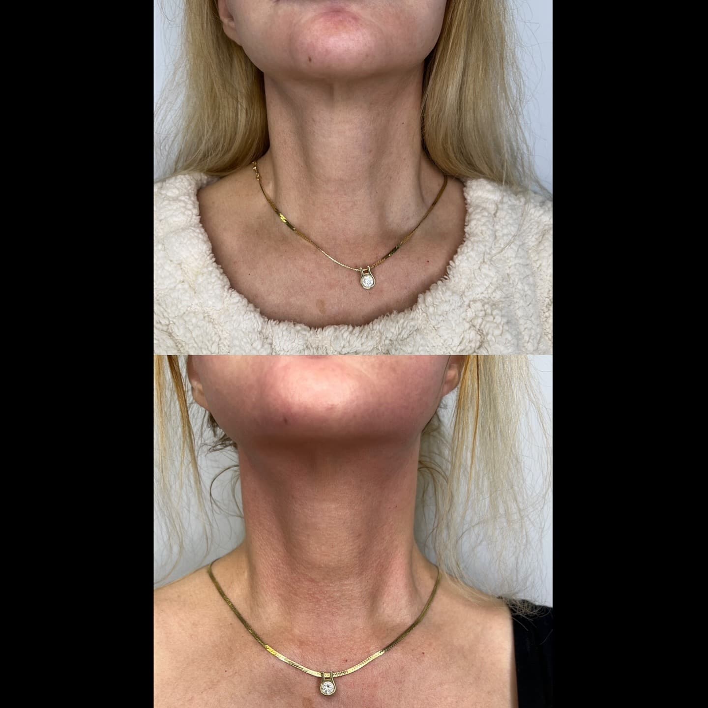 Neck and jawline result, Grey Aesthetics Newport Beach
