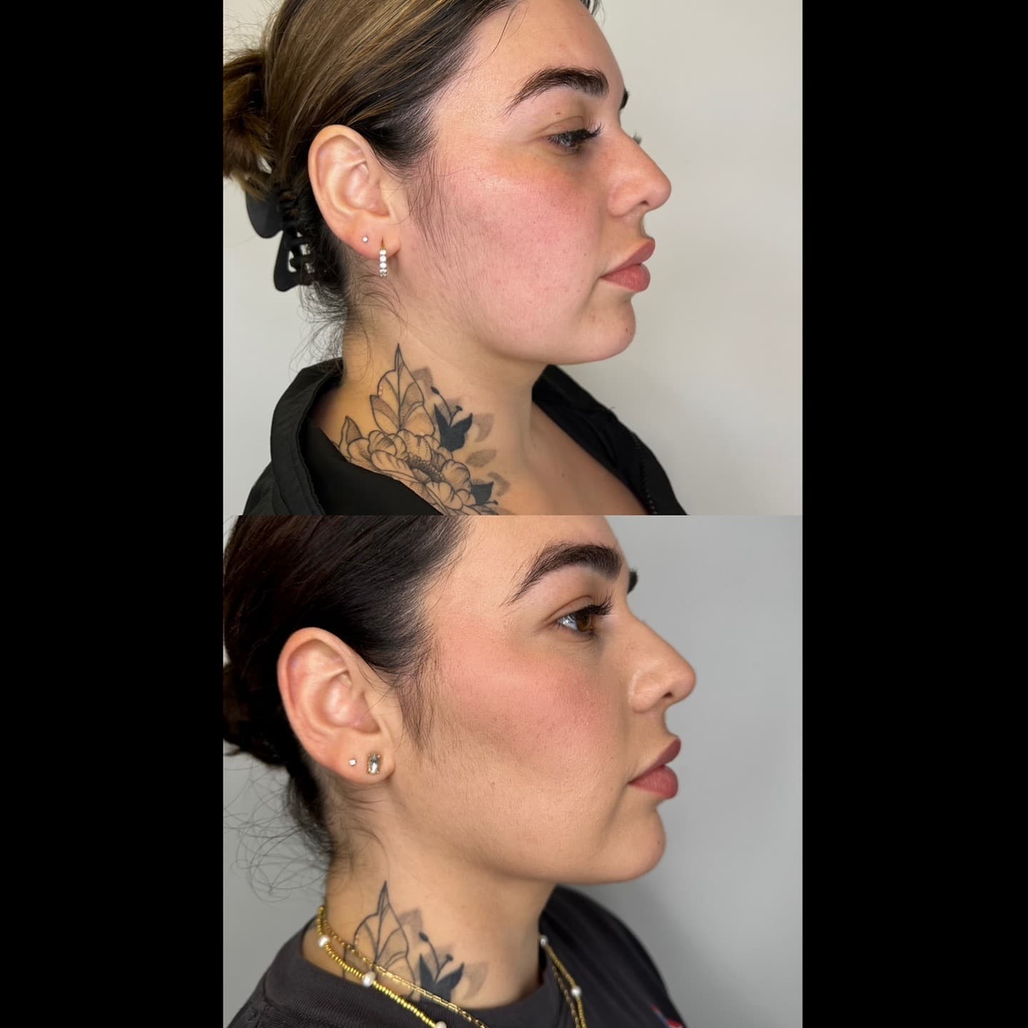 Jaw and neck profile result, Grey Aesthetics Newport Beach