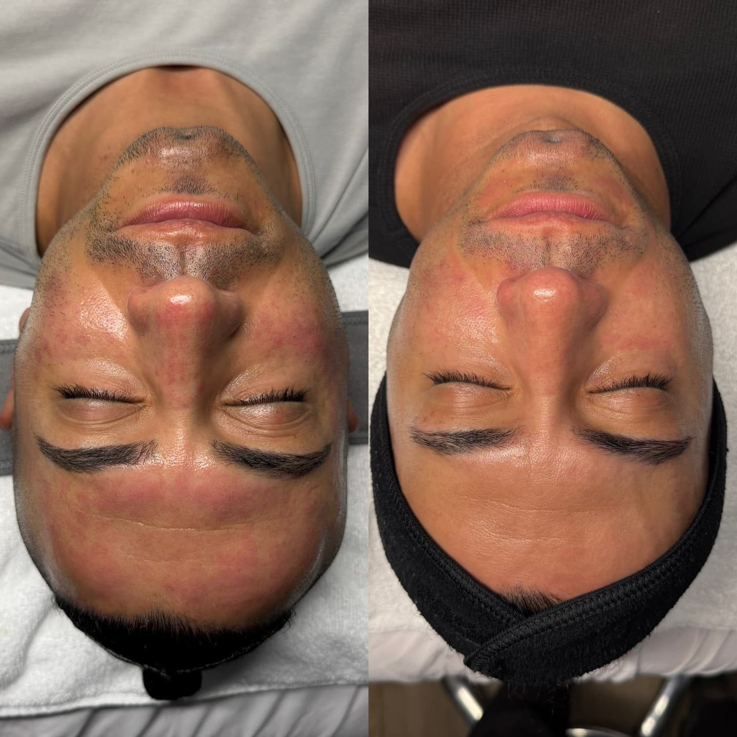 Chin and jawline texture result, Grey Aesthetics Newport Beach