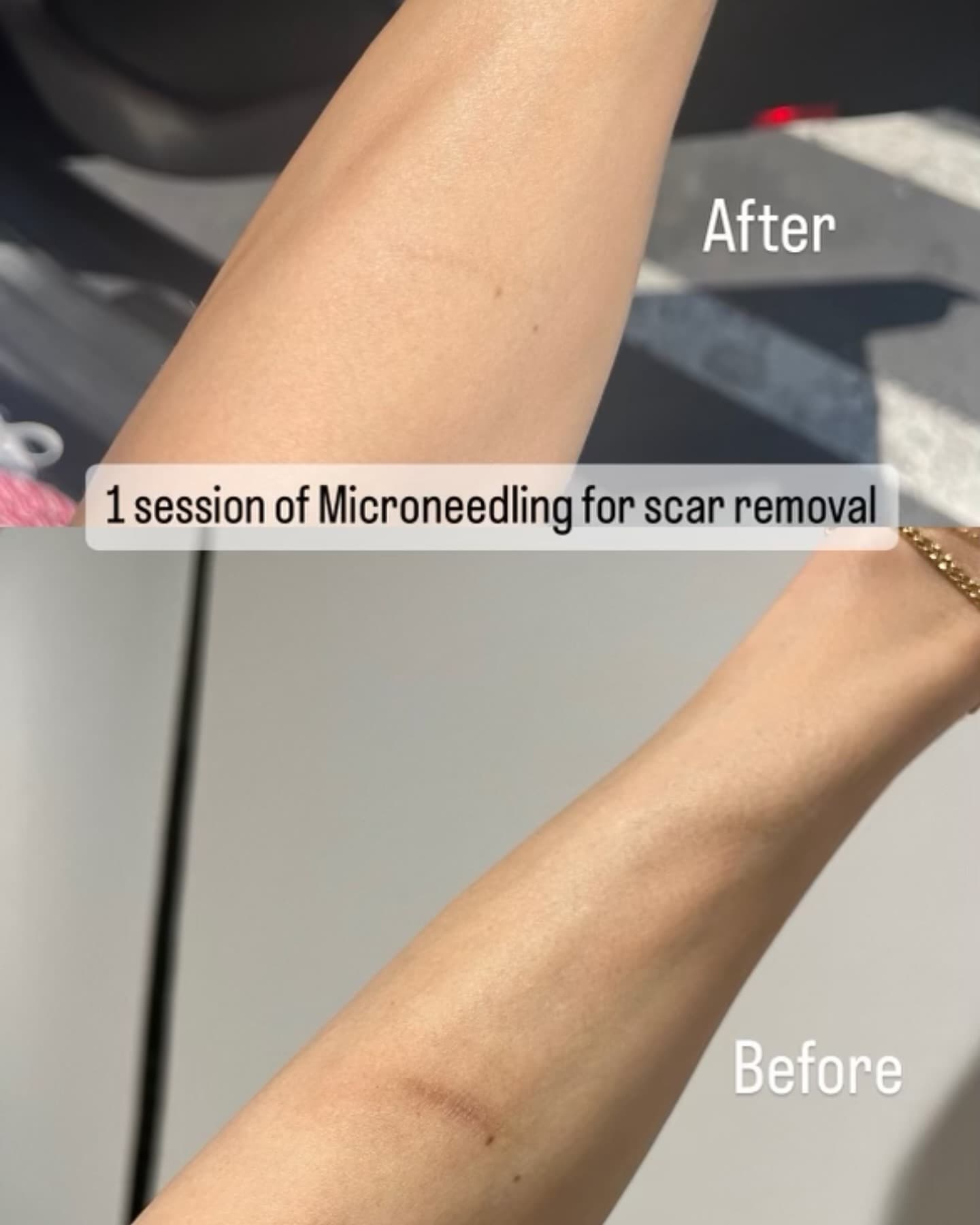 Arm scar removal result, Grey Aesthetics Newport Beach