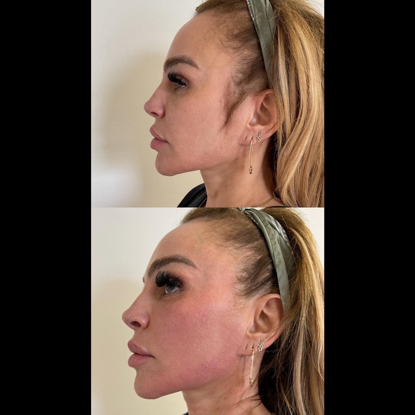 Jawline and neck profile, Grey Aesthetics Newport Beach
