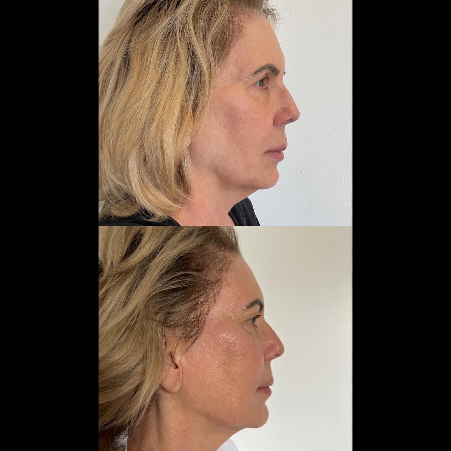 Facial profile result, Grey Aesthetics Newport Beach