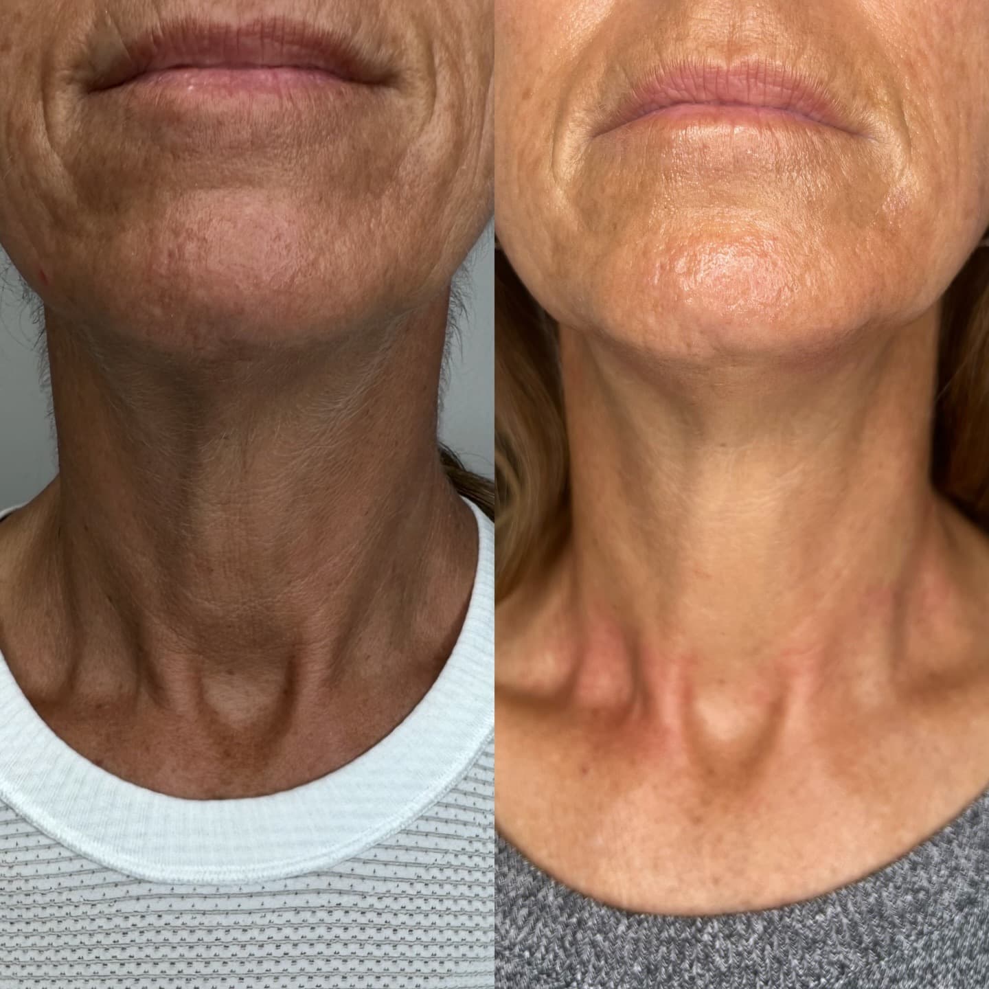 Neck contour result, Grey Aesthetics Newport Beach