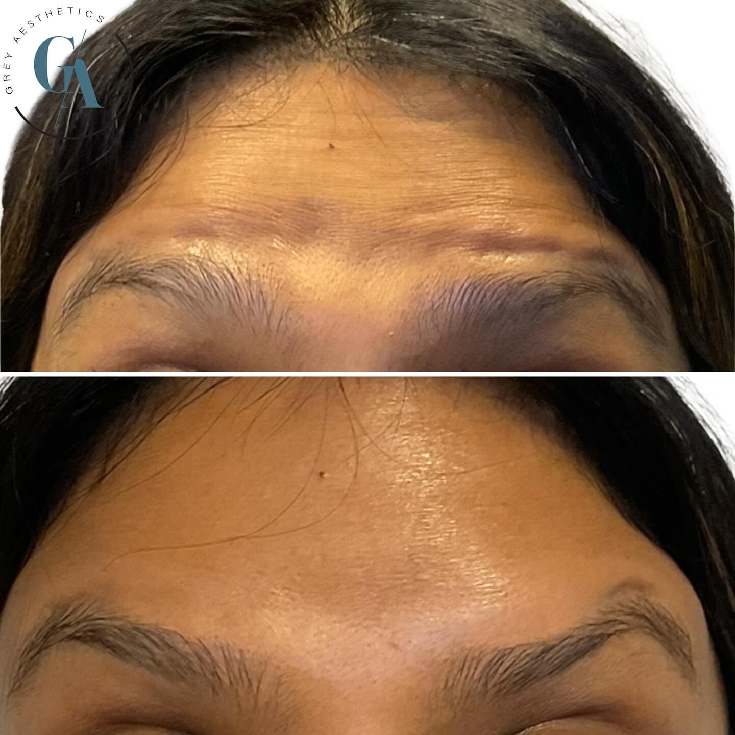 Frown line result, Grey Aesthetics Newport Beach