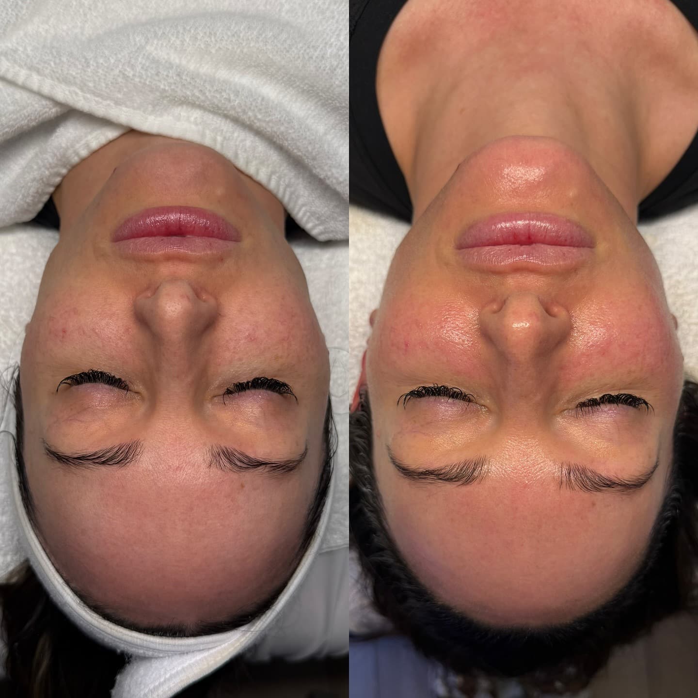 Skin clarity result, Grey Aesthetics Newport Beach